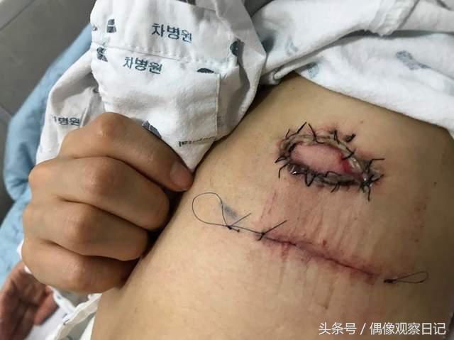 韓國女星醫療事故留下驚悚傷痕！ 向醫院反應不被理會憤怒公開！