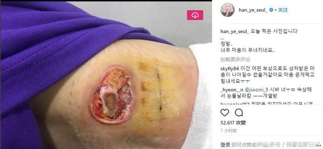 韓國女星醫療事故留下驚悚傷痕！ 向醫院反應不被理會憤怒公開！